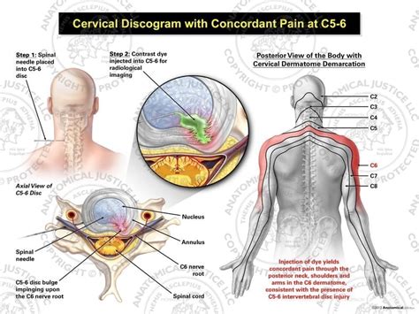 C5 C6 Bulging Disc Symptoms Cervical Radiculopathy Hand And Arm Pain ...