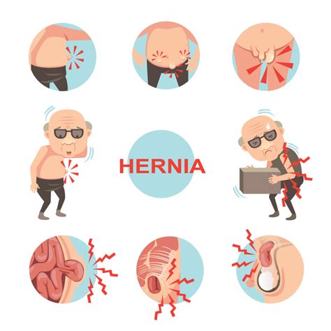 Hernia disease - Causes, Symptoms, Types and Treatment - Apollo Blog