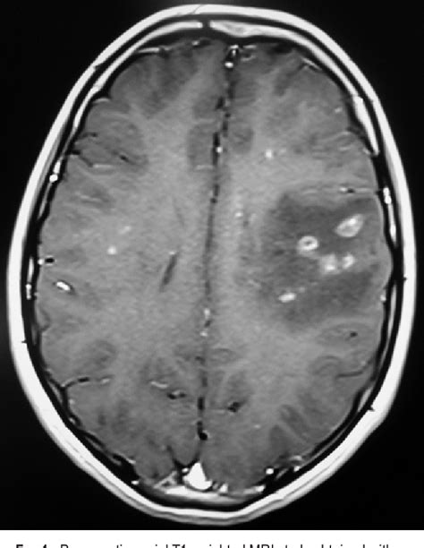 Figure 1 from Angiography-negative primary angiitis of the central ...