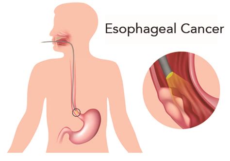 Symptoms of the Most Significant Esophagus Diseases