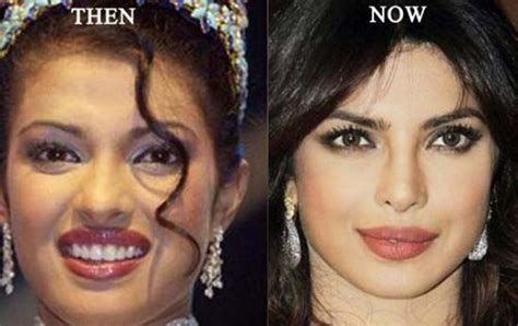 Priyanka Chopra Plastic Surgery Priyanka Chopra Before And After Photo ...