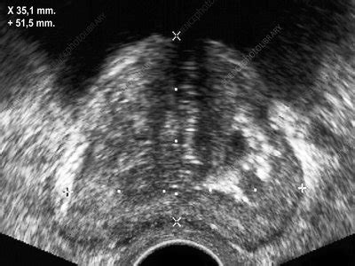 Ultrasound Showing Prostate Cancer - Stock Image - C027/2353 - Science ...