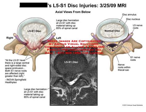 AMICUS Illustration of amicus,injury,disc,spine,MRI,L5-S1,herniation,material,spinal,canal,space ...