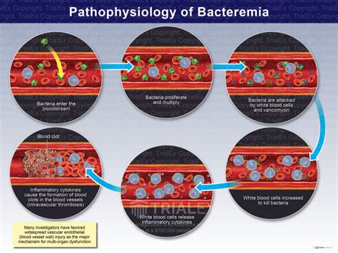 Pathophysiology of Bacteremia - Trial Exhibits Inc.