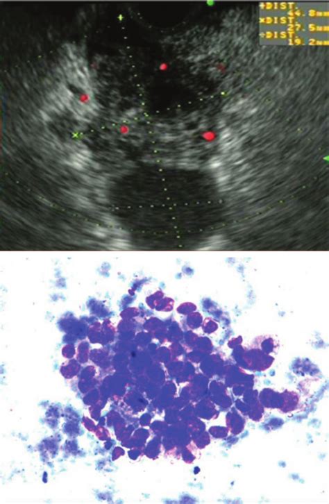 Endoscopic ultrasound of common bile duct stones with dilated common ...