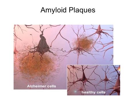 Amyloid plaques