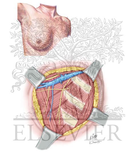 Axillary Lymph Node Dissection