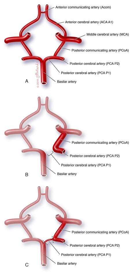 Fetal Circulation Pca - Image to u