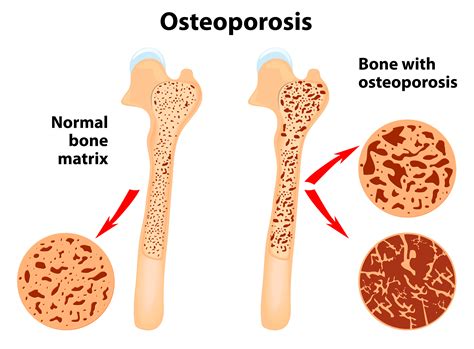 Osteoporosis treatment - StoneRock Dental Care