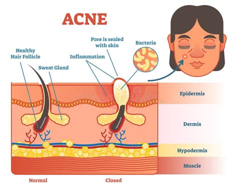 Realistic Skin Acne Anatomy 3d Model Turbosquid 1164399 | Images and ...