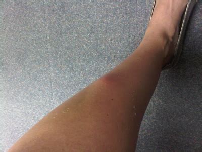 Bumps On Leg When Running Deals | emergencydentistry.com