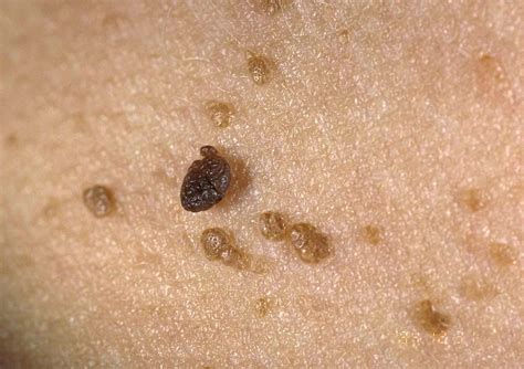 Seborrheic Keratosis: Symptoms, Causes, Diagnosis, and Treatment