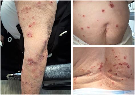 Lisinopril‐associated bullous pemphigoid in an elderly woman: a case ...