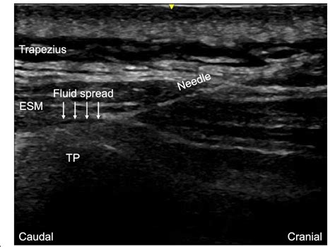 Ultrasound image of erector spinae plane block. The end point is the ...