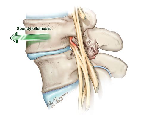 Spine Vertebrae Out Of Place