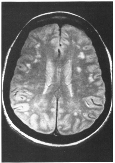 -Cranial Scan of Patient 5. (MRI, T2 image) Periventricular white... | Download Scientific Diagram