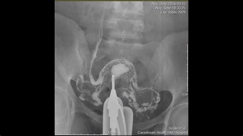 CASE REVIEW hysterosalpingogram HSG - YouTube