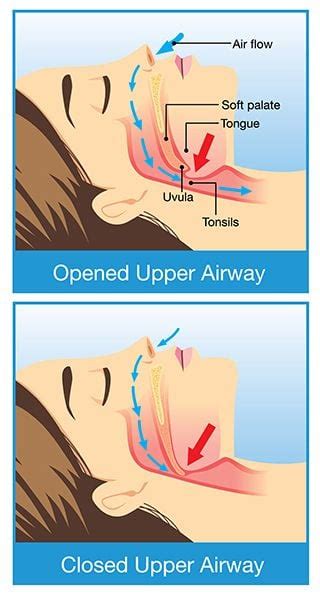 Snoring and Sleep Apnea | Westchester & Newburgh, NY Dentist