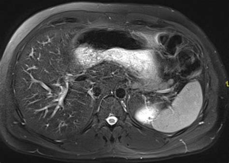 MRI study of the liver with different sequences: A: Diffusion 50-400,... | Download Scientific ...