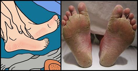 Cracked Feet: 7 Alarming Reasons The Skin On Your Feet Might Be Rough And Broken | Cracked feet ...