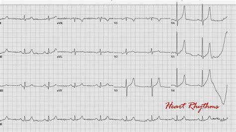 Ecg Rhythms Tented T Waves Of Hyperkalemia | Images and Photos finder