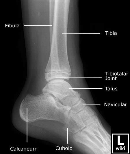 Ankle x-rays - Don't Forget the Bubbles