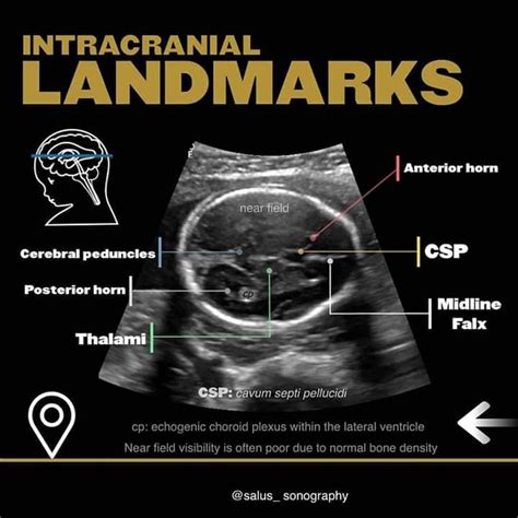 The biparietal diameter (BPD)... - Ultrasound Guided Tips