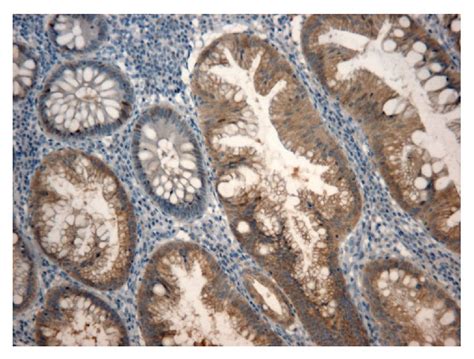 KRAS and BRAF Mutation Detection: Is Immunohistochemistry a Possible Alternative to Molecular ...