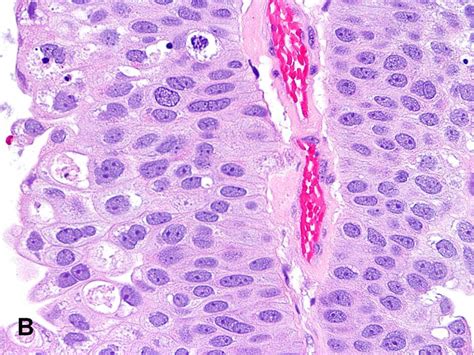 Papillary Urothelial Carcinoma, High Grade - American Urological Association