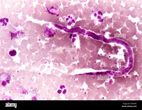 ONCHOCERCA VOLVULUS Stock Photo - Alamy