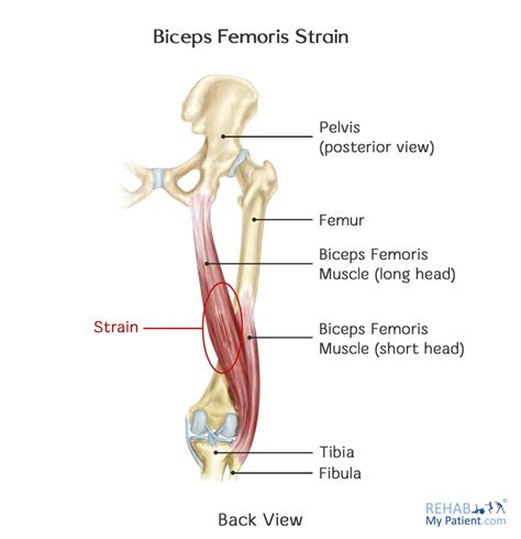 Biceps Femoris Strain | Rehab My Patient