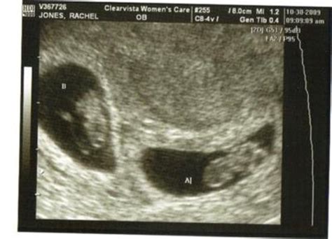 8 Weeks Fraternal Twins Ultrasound