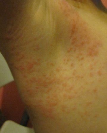 4 yr old's rash in her armpit | BabyCenter