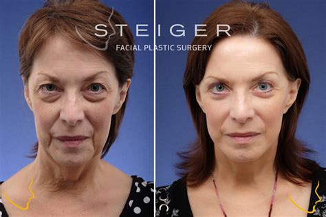Facelift Before and After Photos | Deep Plane Facelift