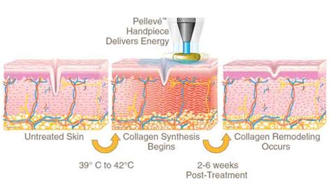 Pelleve Treatment For Eye Area | Puffy Eyes New York