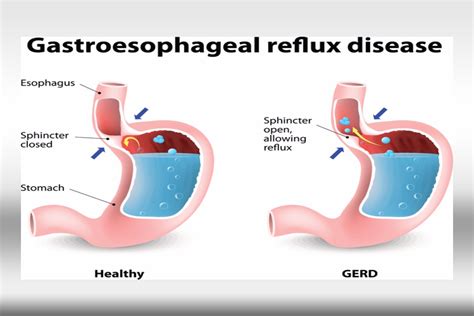 McClure's Choice - Gastroesophageal Reflux Disease - MCC Internal Medicine