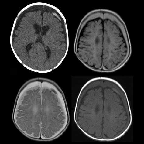 Subdural Hematoma Mri