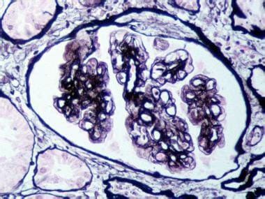 Membranoproliferative Glomerulonephritis: Practice Essentials ...