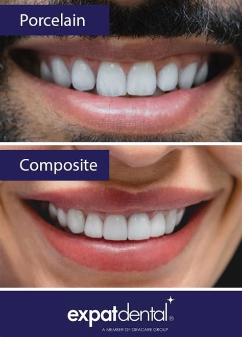 expatdental® - Composite vs Porcelain Veneers