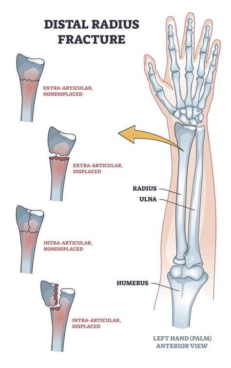 Different Types Of Distal Radius Fractures Seen In The Hand Therapy Clinic | My XXX Hot Girl