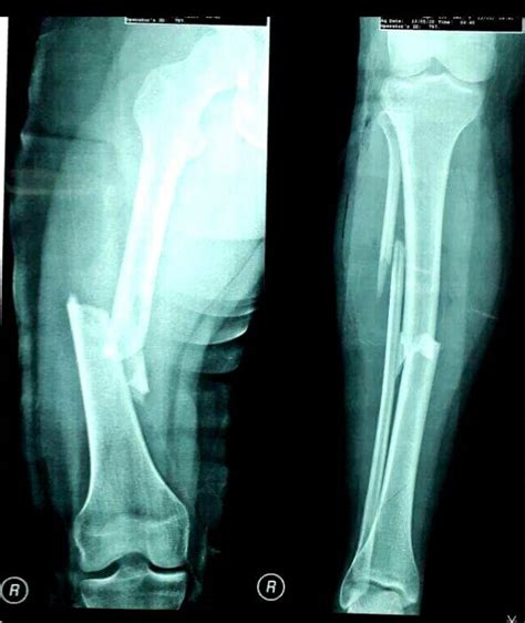 10 Tips for femur fracture recovery — Able Amsterdam