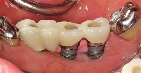 Peri-Implant Infection - A modern Phenomenon or a Long-Ignored Problem? - Oral Health Group