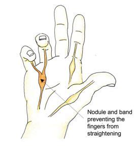 Dupuytren's Fasciectomy - Parkside Hospital