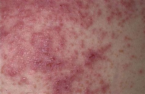 Does Your Gluten Rash Look Like These 5 Photos? | Gluten allergy rash, Gluten symptoms, Celiac ...