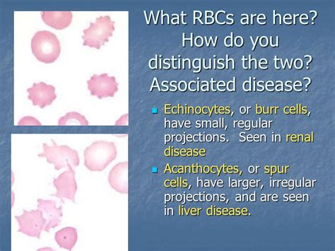 Echinocytes vs acanthocytes | Ascp, Renal disease, Liver disease