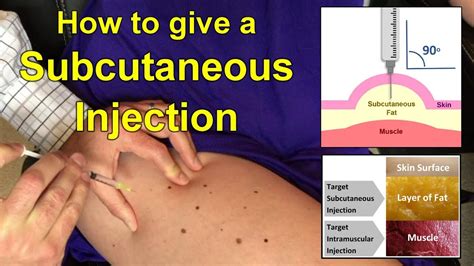 How to Give a Subcutaneous Injection Video - YouTube