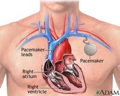 Piezoelectricity Allows Pacemaker To Operate Without A Battery