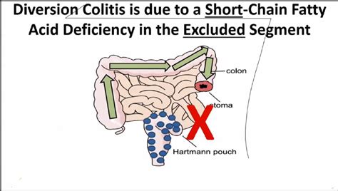 Diversion Colitis - Ulcerative Colitis Causes And Symptoms / Diversion colitis can be easily ...