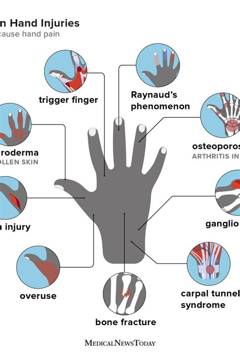 Hand pain: Causes, home remedies, and treatments