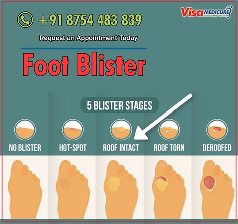 Blisters On Feet: Causes And Treatments Resurchify, 53% OFF